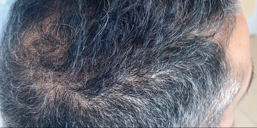 After Procell hair restoration at Skin9 Studio, Oakville