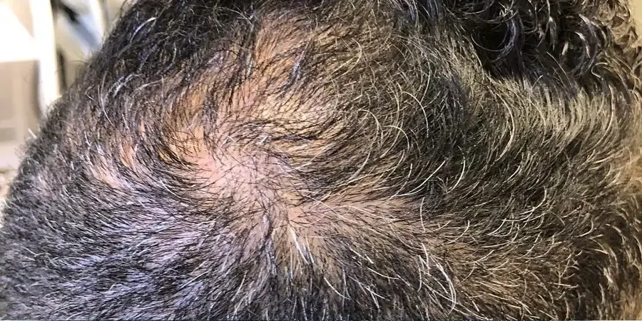 Before Procell hair restoration at Skin9 Studio, Oakville