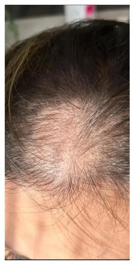 Before Procell hair restoration result at Skin9 Studio, Oakville