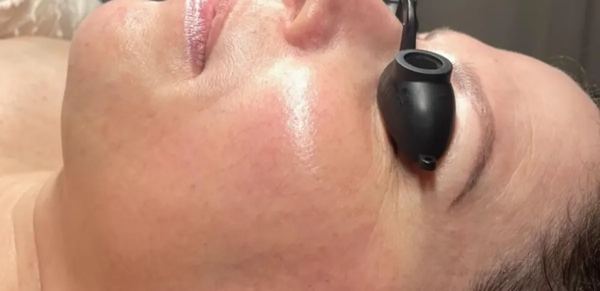 After Procell microchanneling at Skin9 Studio, Oakville