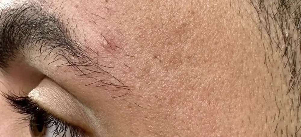 After microchanneling for scar revision at Skin9 Studio, Oakville