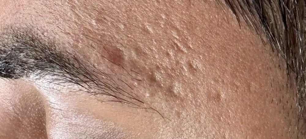 Before microchanneling for scar revision at Skin9 Studio, Oakville